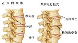 骨质增生常见的症状2.png