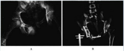骨盆骨折的内固定术.jpg